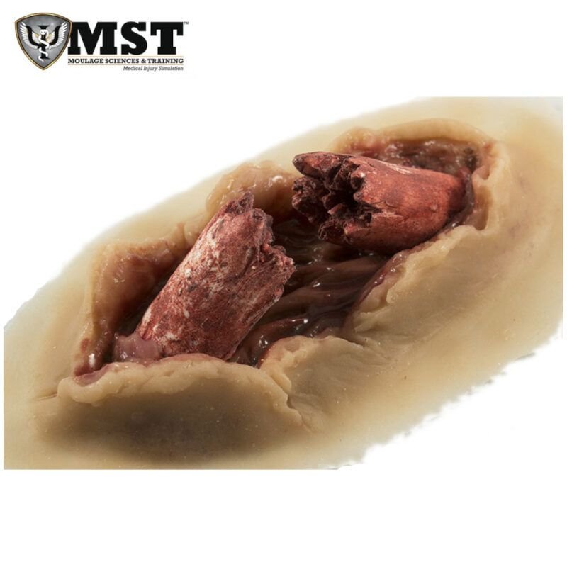 Moulage - Fractura expuesta