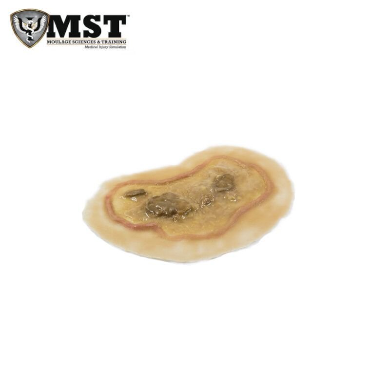 Moulage – Ulceras grandes