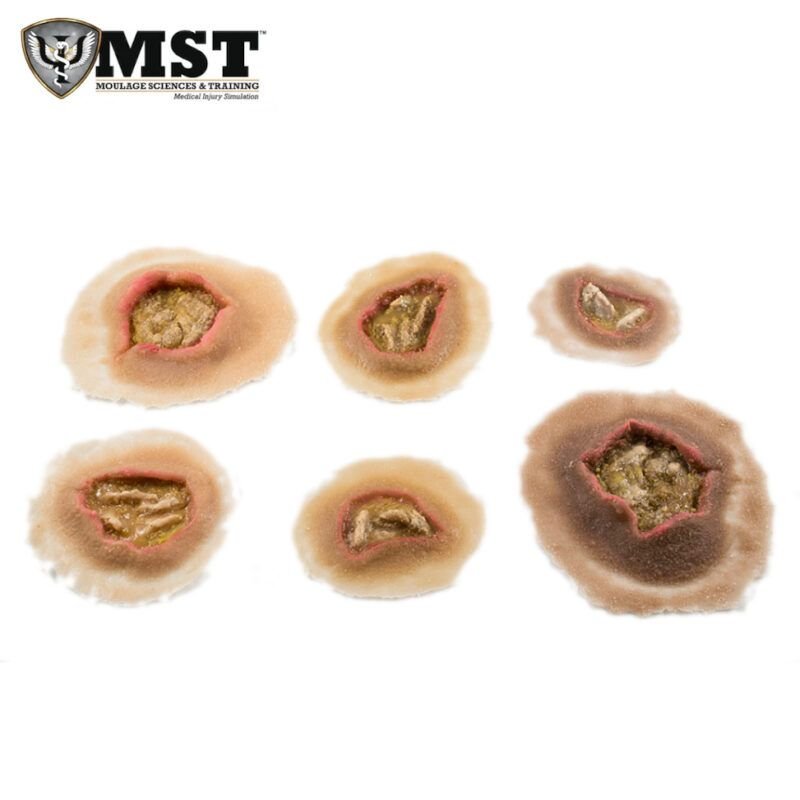 Moulage - Ulceras pequeñas