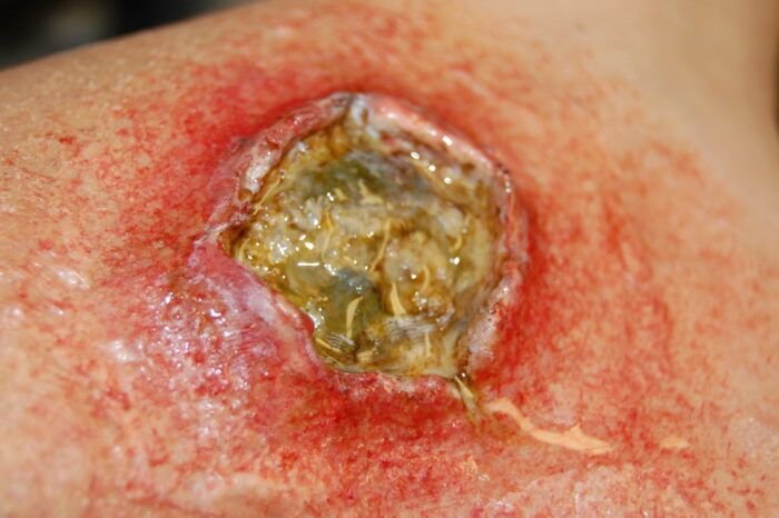 Moulage - Ulceras pequeñas - Imagen 2