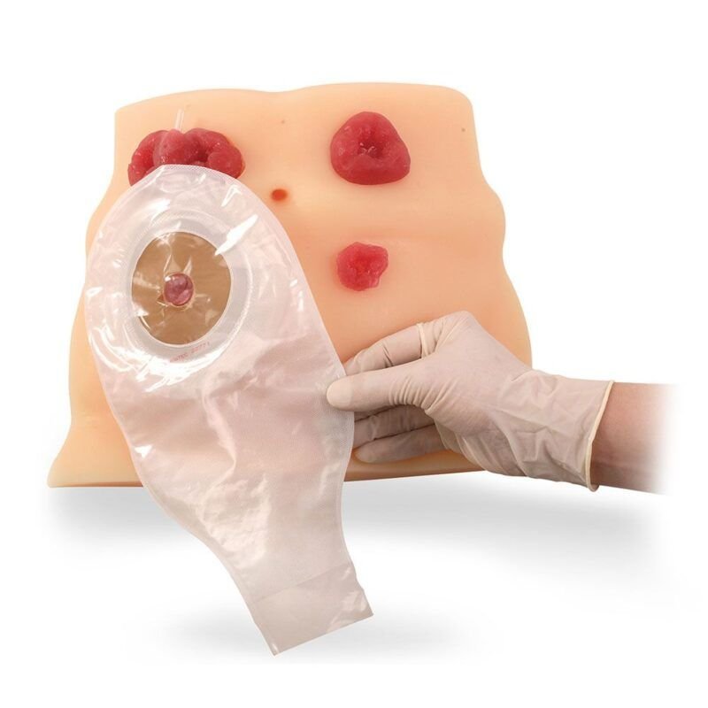 Modelo de cuidado de ostomía de Health Edco